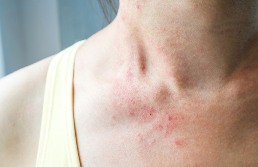 Les bienfaits du chanvre en cas d'eczéma