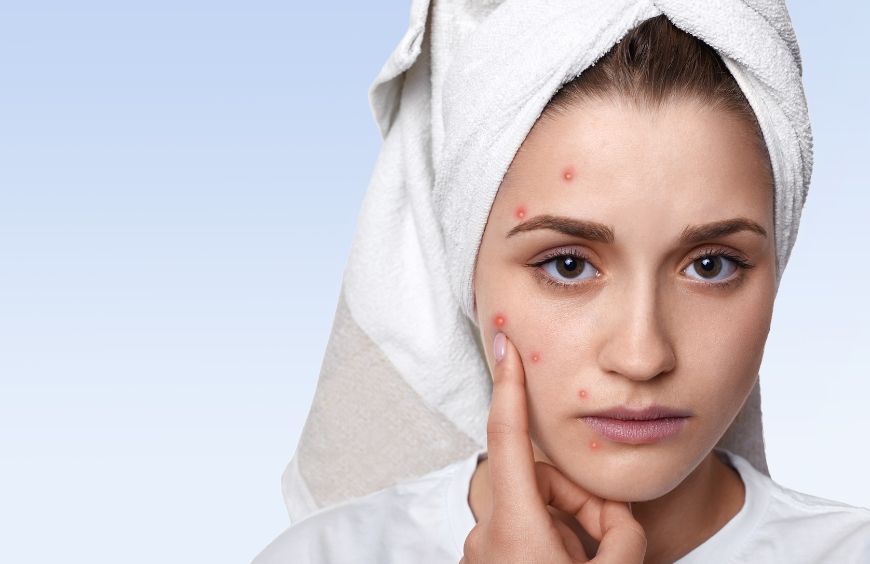 CBD et son action potentielle contre l'acné 